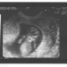 prvi ultrazvok