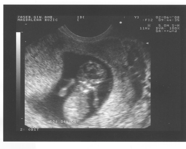 Prvi ultrazvok - foto povečava