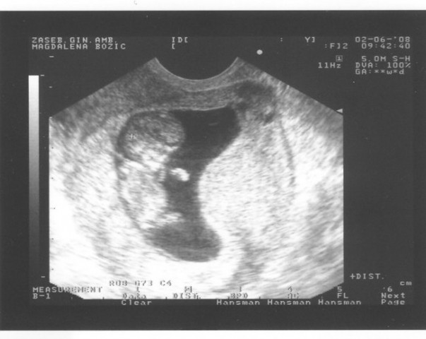 Prvi ultrazvok - foto